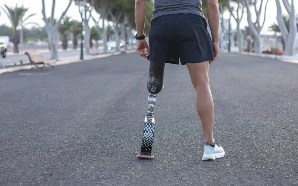 Springfield Amputation Lawyer